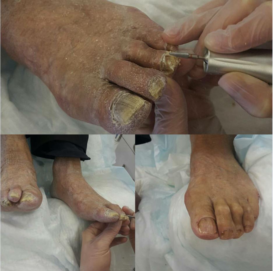 Mantarlı Tırnak Bakımı